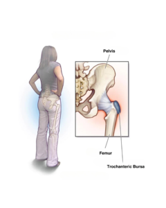 causes of hip bursitis